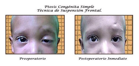 tratamiento_ptosis_palpebral/ptosis_congenita_simple