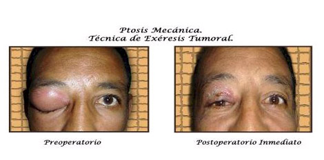 tratamiento_ptosis_palpebral/ptosis_mecanica_tumor