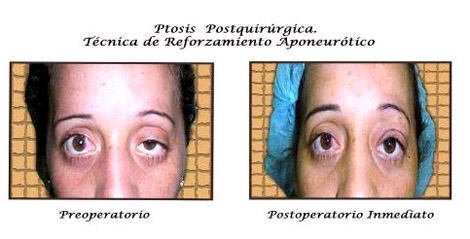 tratamiento_ptosis_palpebral/ptosis_postquirurgica_reforzamiento