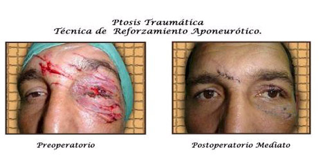 tratamiento_ptosis_palpebral/ptosis_traumatica_reforzamiento