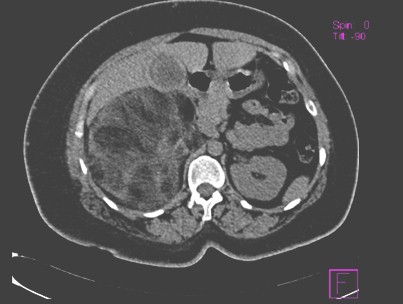 mielolipoma_suprarrenal_gigante/TAC_abdominal_abdomen