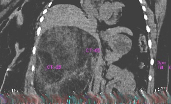 mielolipoma_suprarrenal_gigante/TAC_imagen_torax