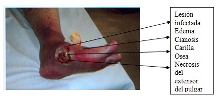 oxigenacion_hiperbarica_ozono/escara_pie_diabetico