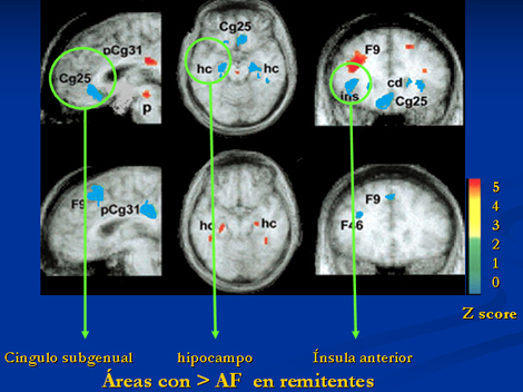 remision_depresion_tardia/depresion_tardia_refractaria