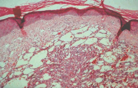 sarcoma_kaposi_iatrogenico/celulas_fusocelulares_arremolinadas sarcoma_kaposi_iatrogenico/celulas_fusocelulares_arremolinadas