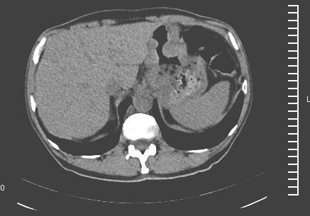 tumor_gastrico_caso/clinico_TAC_abdominal