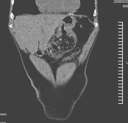 tumor_gastrico_caso/clinico_diagnostico_imagen tumor_gastrico_caso/clinico_diagnostico_imagen
