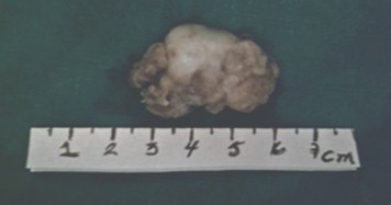 angiofibroma_nasal_mujer/tumor_extraido_resecado