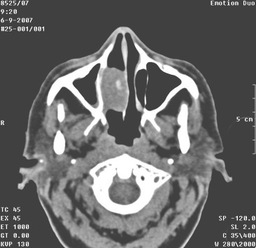angiofibroma_nasal_mujer/tumoracion_nasal_tumor