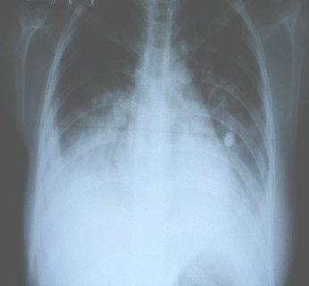 dengue_hemorragico_caso/RX_radioopacidad_derecha dengue_hemorragico_caso/RX_radioopacidad_derecha