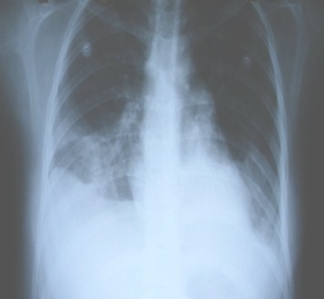 dengue_hemorragico_caso/RX_torax dengue_hemorragico_caso/RX_torax