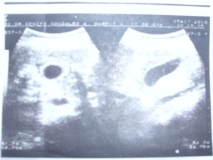 dengue_hemorragico_caso/ecosonograma_abdominal dengue_hemorragico_caso/ecosonograma_abdominal