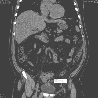 diverticulitis_fistula_enterovesical/TAC_fistulizacion_abdominal