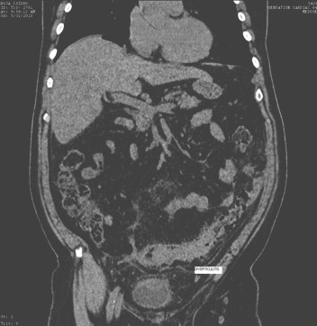 diverticulitis_fistula_enterovesical/diverticulo_diverticulos_inflamacion