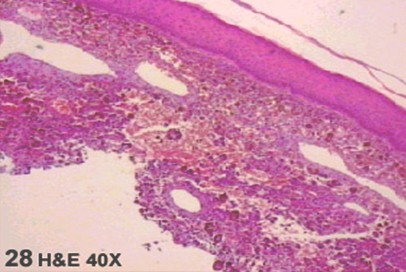 fibrohistiocitoma_maligno_vagina/FHM_FHA_histologia