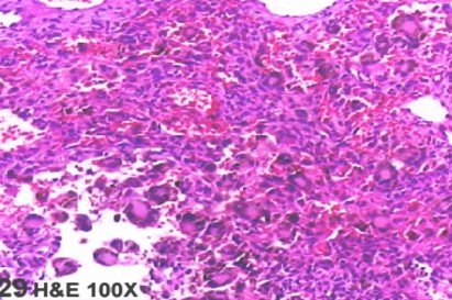 fibrohistiocitoma_maligno_vagina/anatomia_patologica_hematoxilina_eosina