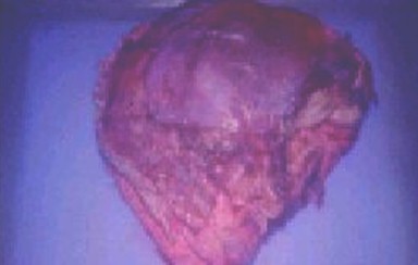 fibrohistiocitoma_maligno_vagina/imagen_macroscopica_tumor