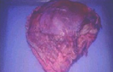 fibrohistiocitoma_maligno_vagina/imagen_macroscopica_tumor fibrohistiocitoma_maligno_vagina/imagen_macroscopica_tumor