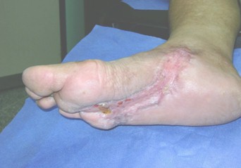 heberprot_pie_diabetico/curacion_escara_cronica heberprot_pie_diabetico/curacion_escara_cronica