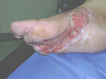 heberprot_pie_diabetico/escara_cronica_diabeticos heberprot_pie_diabetico/escara_cronica_diabeticos