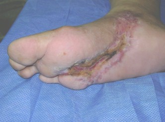heberprot_pie_diabetico/evolucion_ulcera_diabetica heberprot_pie_diabetico/evolucion_ulcera_diabetica