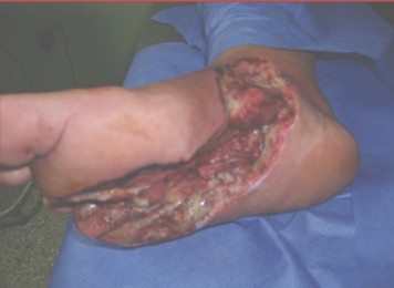 heberprot_pie_diabetico/ulcera_escara_diabetica heberprot_pie_diabetico/ulcera_escara_diabetica