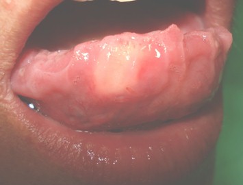 lipoma_lingual_caso/aspecto_lengua_escrotal