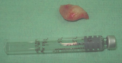 lipoma_lingual_caso/aspecto_macroscopico_lengua lipoma_lingual_caso/aspecto_macroscopico_lengua