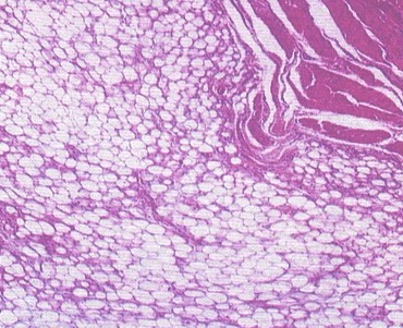 lipoma_lingual_caso/capsula_celulas_adiposas lipoma_lingual_caso/capsula_celulas_adiposas