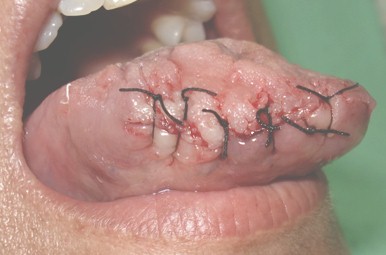 lipoma_lingual_caso/cirugia_lengua_escrotal