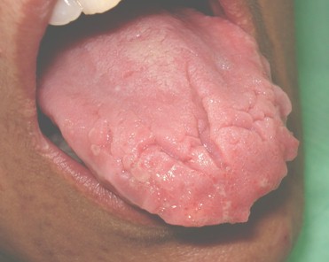 lipoma_lingual_caso/clinico_lengua_escrotal