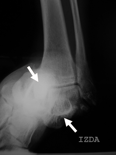 luxacion_periastragalina_astragalo/radiografia_simple_tobillo_rx luxacion_periastragalina_astragalo/radiografia_simple_tobillo_rx