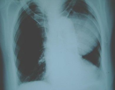 masa_mediastinal_mediastinica/Rx_torax_aneurisma