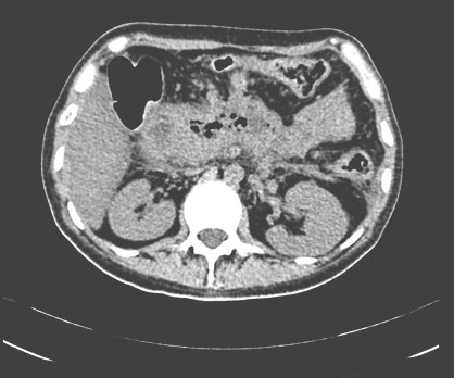 pancreatitis_aguda_enfisematosa/TAC_crecimiento_pancreas pancreatitis_aguda_enfisematosa/TAC_crecimiento_pancreas