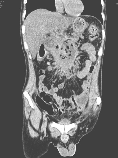 pancreatitis_aguda_enfisematosa/cabeza_cuerpo_pancreas