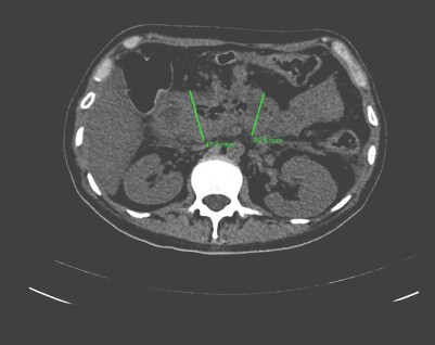 pancreatitis_aguda_enfisematosa/marco_duodenal_pancreas pancreatitis_aguda_enfisematosa/marco_duodenal_pancreas