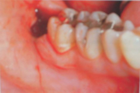 prevalencia_causas_alveolitis/lesion_molar_inferior