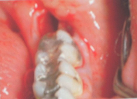 prevalencia_causas_alveolitis/proceso_inflamatorio_agudo prevalencia_causas_alveolitis/proceso_inflamatorio_agudo