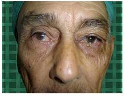 ptosis_palpebral_geriatria/reforzamiento_aponeurotico_postoperatorio