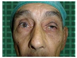 ptosis_palpebral_geriatria/reforzamiento_aponeurotico_preoperatorio