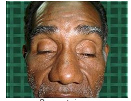 ptosis_palpebral_geriatria/suspension_frontal_preoperatorio