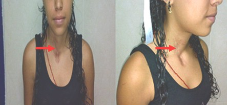 recanalizacion_esofagica_espontanea/herida_cervical_cicatrizada recanalizacion_esofagica_espontanea/herida_cervical_cicatrizada