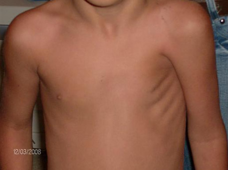 sindrome_Poland_caso/sindrome_Poland_1 sindrome_Poland_caso/sindrome_Poland_1
