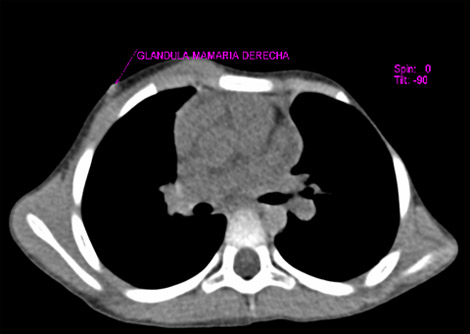 sindrome_Poland_caso/sindrome_Poland_3