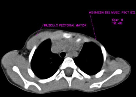 sindrome_Poland_caso/sindrome_Poland_4