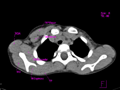 sindrome_Poland_caso/sindrome_Poland_5