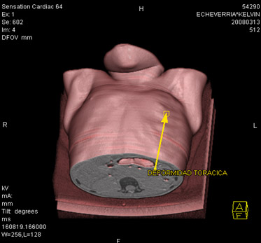 sindrome_Poland_caso/sindrome_Poland_6