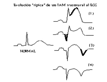 sindrome_coronario_agudo/ECG_