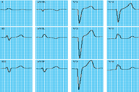 sindrome_coronario_agudo/ECG_2