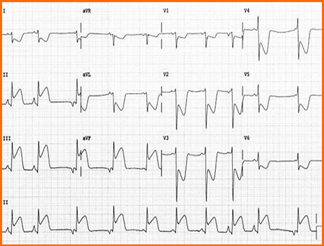 sindrome_coronario_agudo/ECG_3